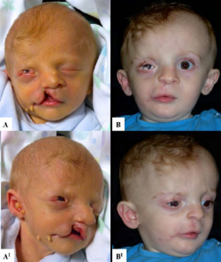 A: preoperative; B: postoperative.