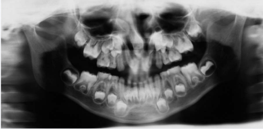 Supernumerary tooth in the lower anterior region, in an individual with G/BBB syndrome