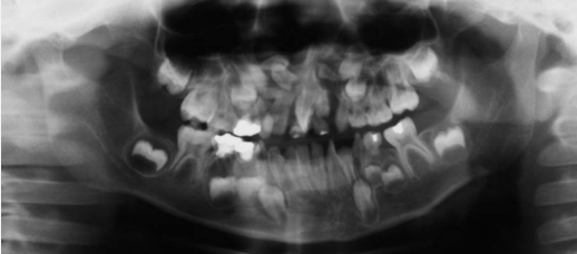 Supernumerary teeth in the upper anterior region, in an individual with CLP/H