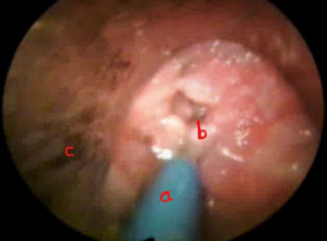 Severely compromised airway with Frova in place.  a. Frova intubating catheter b. Glottis covered with multiple papillomae c. Direct Laryngoscope.