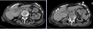 Abdominal CT scan. 6 x 7 x 13 cm heterogeneous collection  of the right infra hepatic region with central hyperdensity suggestive  of hematoma versus the high possibility of hemorrhagic cholecystitis.