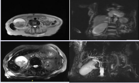 Abdomen MRI showing a distended gallbladder 12 x 7  x 6.8 cm with heterogeneous density with high T1 and low T2 signal  intensity seen in its lumen suggestive of hemorrhagic cholecystitis.  The intra and extrahepatic ducts are normal in caliber. No visible  calculi.
