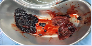 Acalculous gallbladder filled with dark blood clots.