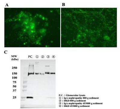 Immunofluorescence of urine sediment (A) and supernatant (B) of a patient with IgA nephropathy (x400). The supernatant was ultracentrifuged at 453000 × g for 2 h, and the resulting precipitate was subjected to conventional immunofluorescence staining using a monoclonal  antibody against PCX (clone 22A4) and a FITC (fluorescein isothiocyanate)-labeled anti-mouse IgG.  (C) Western blotting of the urine of patients with IgA nephropathy (lanes 1 and 3) and diabetic kidney disease (DKD) (lanes 2 and 4). Glomerular  lysate (PC) was used as a positive control. Bands at 160-170 kDa were observed, which correspond to podocalyxin.