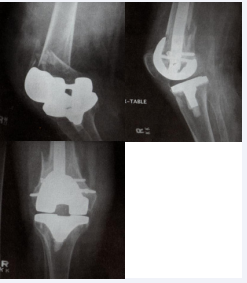 Figure 1 Supracondylar periprosthetic femur fractures treated with retrograde intramedullary nailing
