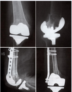 Figure 2 Supracondylar periprosthetic femur treated in a novel fashion with periarticular plate and intramedullary fibular struct allograft.