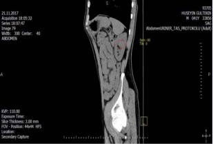 Bertini colon in right kidney.