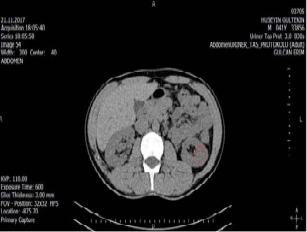 Bertini colon in left kidney.