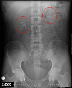 Double collecting system in right and left kidney.