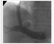 a Implantation of the reducing stent