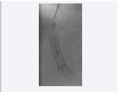  Occlusion of the reducing stent with a vascular plug.