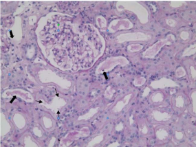 Light micrograph showing slight glomerular basement  membrane vacuolar degeneration, no obvious pathological change was  observed in glomeruli. The renal tubular epithelial cells multiple focal  brush hair loss (black arrow) and the cell debris in the lumen could be  seen (solid arrow). (periodic acid-Schiff, original magnification ×200).