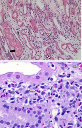 Light micrograph shows the renal tubular epithelial cells  vacuolar degeneration (solid arrow). The renal interstitial was  edema. There were focal interstitial inflammatory cells Infiltrates,  predominantly lymphocytes and mononuclear cells, and a small  amount of eosinophils (black arrow). Periodic acid-Schiff, original  magnification.