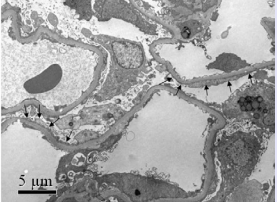 Electron micrograph shows the focal effacement of  glomerular foot processes (black arrows) without deposits or  basement abnormalities (original magnification ×5,000).