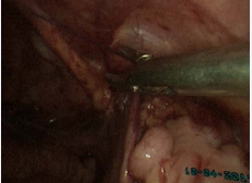  A photograph showing laparoscopic view of Right proximal UDT in  the bilateral case during laparoscopic hernia repair by purse string suture.