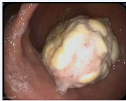 Figure 1 Endoscopic image of gastric polyp.
