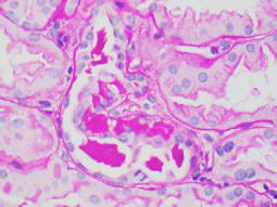 Dense eosinophilic granular cast material within an injured  tubule. Note the mitotic figure at the bottom, arrow. (magnification  x400; PASstain). 