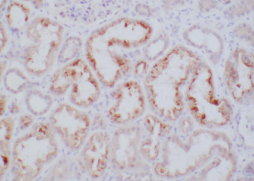 Diffuse granular to globular staining within the cytoplasm of  many attenuated tubules. (magnification x200; myoglobin stain). 