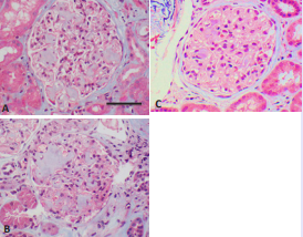 Masson’s Trichrome. All magnification 400X. Similar staining  for all 3.A: AL kappa restricted; B: AL lambda restricted; C: AA type.  Scale bar 50 microns.