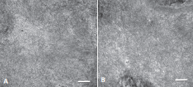 Electron Microscopy. A: Kappa restricted amyloid (Mag.  20,000X). Scale bar 500 nm. B: Lambda restricted amyloid (Mag.  40,000X). Scale bar 250 nm