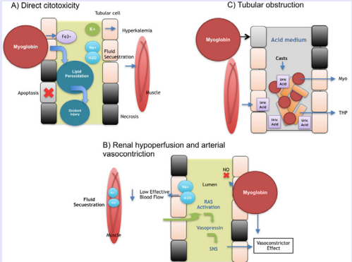 Mechanisms of AKI induced by rhabdomyolysis. In panel a) We observe direct damaged one of those is the release of free iron from the myoglobin due to fenton reactions and lipid peroxidation  causing oxidant injury therefore necrosis and apoptosis. Panel b) Hypoperfusion is due to three mechanisms: 1) Decrease of venous volume  secondary to fluid sequestration in damaged muscle and 2) Activation of neuroendocrine systems and local vasoconstriction 3) Inhibition of nitric  oxide by myoglobin and vasoconstriction. Panel c), Myoglobin interacts with tamm-horsfall protein and precipitates forming casts causing tubular  obstruction. This mechanism is enhanced by acid medium. On the other hand, damaged muscle release uric acid which precipitates un tubules  favoring its obstruction