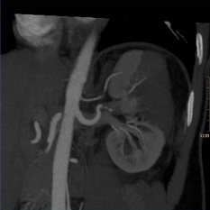 Computed tomography (CT) angiography revealed beading  consistent with fibromuscular dysplasia (FMD) at the distal main  renal artery at the junction of the bifurcating branches