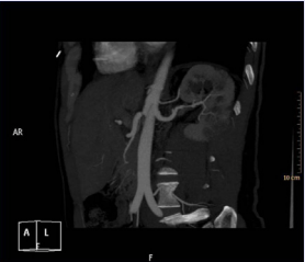 Tapered narrowing and occlusion in the more proximal  artery