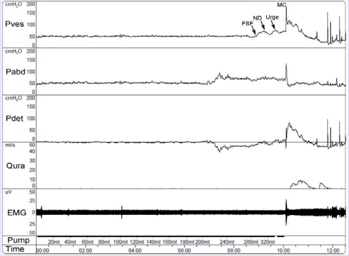 2016 Cystometrogram: A #7 French, air-charged, single lumen catheter,was used to infuse sterile water at a medium fill rate. Intravesical  pressure [Pves], was recorded. A rectal catheter [Pabd] was placed to monitor abdominal pressure. The difference between Pabd and Pves is the  actual detrusor pressure [Pdet]. First sensation of bladder filling [FSF] was noted at 291ml, normal desire [ND] at 314ml, and Urgency at 334ml.  Micturition command [MC] was given once the individual reached capacity [360ml]. Measurement of urinary flow [Qura] demonstrates onset at MC.  Electromyography [EMG] indicates a rise in activity just prior to void with relaxation during the void.