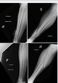 Figure 1 Anterior-Posterior and Lateral initial radiographs of a 49 year-old male who sustained bilateral segmental tibia fractures as a pedestrian stuck by a motor vehicle. The left tibia fracture was classified as a Grade I openfracture.