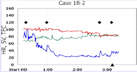 Time course of HR (green), SV (blue) and TFC (red)  throughout a hemodialysis session.