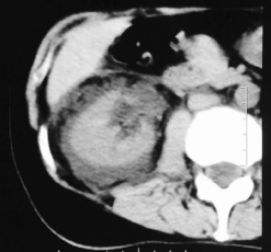 Abdominal CT. Abundant fluid collection in perinephric area  and hydronephrosis grade II.