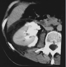 Abdominal CT with contrast enhanced. Free passage of  contrast material from the left renal pelvis to around the kidney and  spontaneous rupture of the renal pelvis.