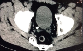 Abdominal CT. Calculi in left terminal ureter