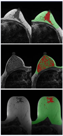 Breast (green color) and fibroglandular tissue segmentation (red color) in three women with different breast size, morphology, and imaging quality. Note the fibroglandular tissue can be accurately segmented (red color).