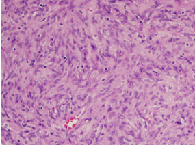 Mixed spindle cells with foci of epitheliod tissues. Mitotic rate of 7/50 HPF.