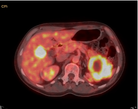 CT/PET scan showing liver nodule and large left upper quadrant mass with necrotic center