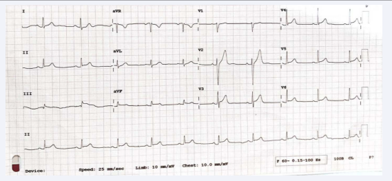 ECG showed ST elevation in Lead II, III, aVf, and V2-V4.