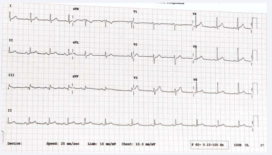 ECG was again performed with trop-I levels which were 5.611 this time.