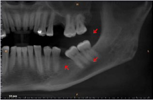 Cone Beam Computed Tomography, panoramic slice showing multiple uni locular hypondense lesions, with well-defined margins characterized by “punched-out” lesions in the left mandibular angle and ramus.