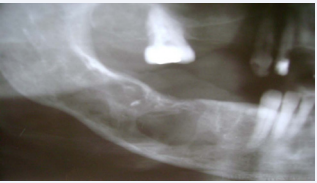 Panoramic radiography showing large radiolucent areas with areas of poorly defined and others with sclerotic margins, characterizing a “soap-bubble” pattern, localized in the right side of the mandibular body.