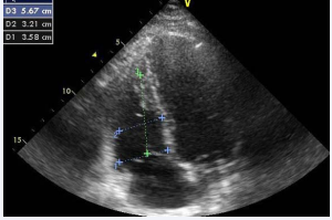 Measure of RV Dimension (Basal-D1, mid-D2 and longitudinal-D3 diameters).