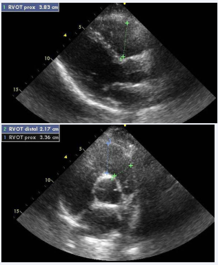 Measure of RVOT (Parasternal long axis and Parasternal short axis).