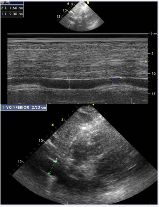Measure of IVC (Subcostal view).