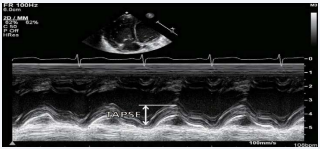 Measure of Tricuspid annular plane systolic excursion (TAPSE).