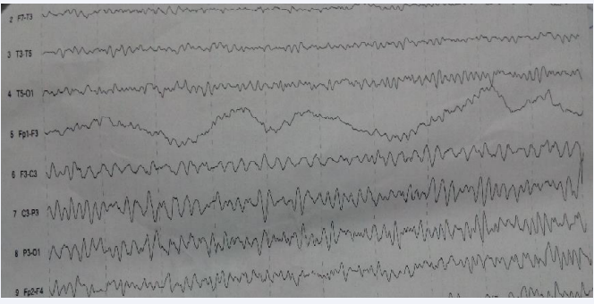 Daytime EEG: Irregular spike, spike wave (or arousal EEG) activities were determined on left frontal, parietal and occipital electrodes. No  difference was shown by hypoventilation and fotic stimulation.