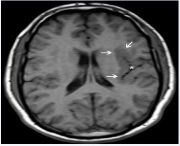 Axial T1 weighted MR image shows left temporo-parietal heterotopic gray matter (arrows) due to a closed-lip schizencephaly (asterisk).