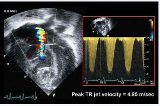 Measure of systolic pulmonary artery pressure.
