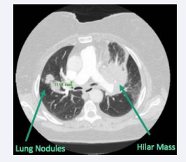Figure 1 Left suprahilar mass with right upper lung nodules  suggestive of metastasis.