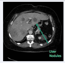 Figure 2 Metastasis in the liver.