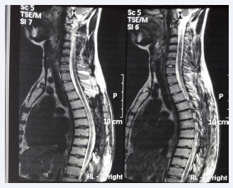 Figure 2 Showing laminectomy with complete resolution of mass.